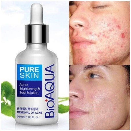 Serum antiacne BIOAQUA
